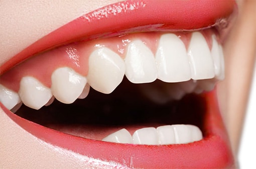 Cosmetic Dental Bonding