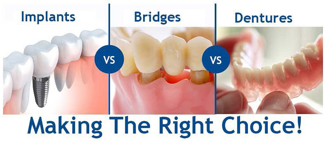 Implants Vs Bridges Dentures