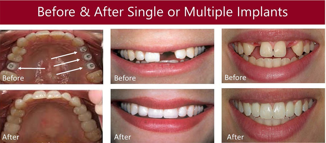 Before & After Pictures of Dental Implants Treatment