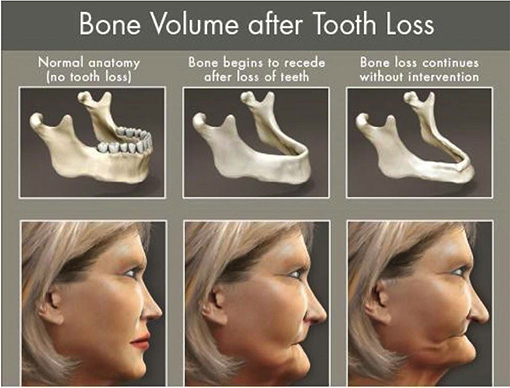 Bone Volume After Tooth Loss