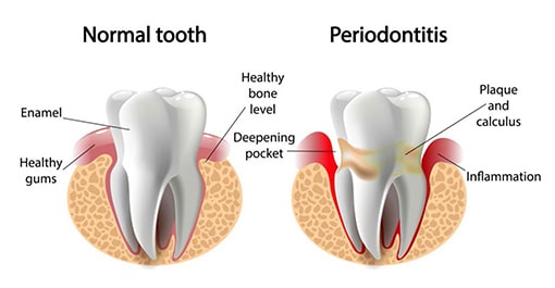 Normal Tooth vs Periodontitis