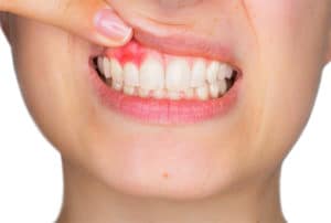 Gum Disease Affect Body Health