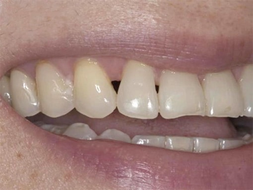 Gap between teeth