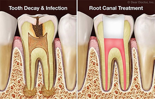 Root Canal Treatment Process