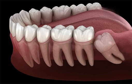 Wisdom Tooth Extraction in Newmarket